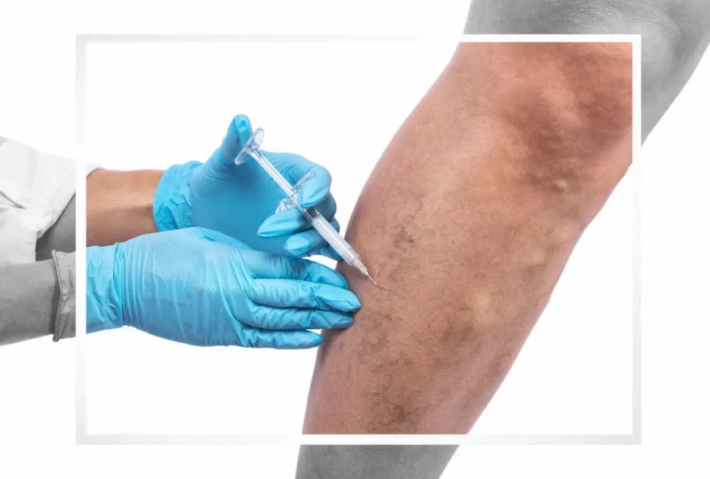 Sclerotherapy-Urban Medspa -Weight Loss Center-Cliff Cameron Dr-Charlotte- NC
