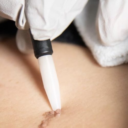urbanmedspacharlotte-Mole and Skin Tag Removal-gallery-new-in-charlottle-nc