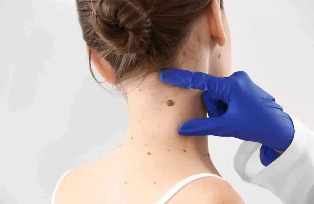 Moles & Skin Tag Removal: Safe & Effective Procedures