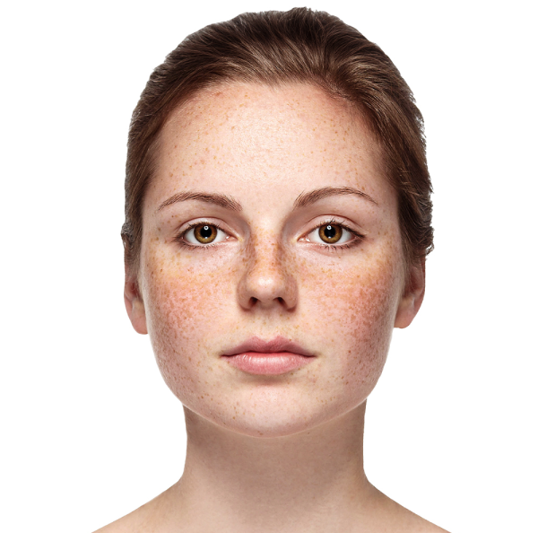 Melasma and Hyperpigmentation Treatments