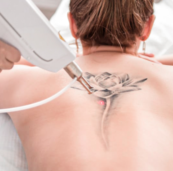 Laser Tattoo Removal with Picosecond