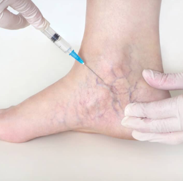 Schlerotherapy