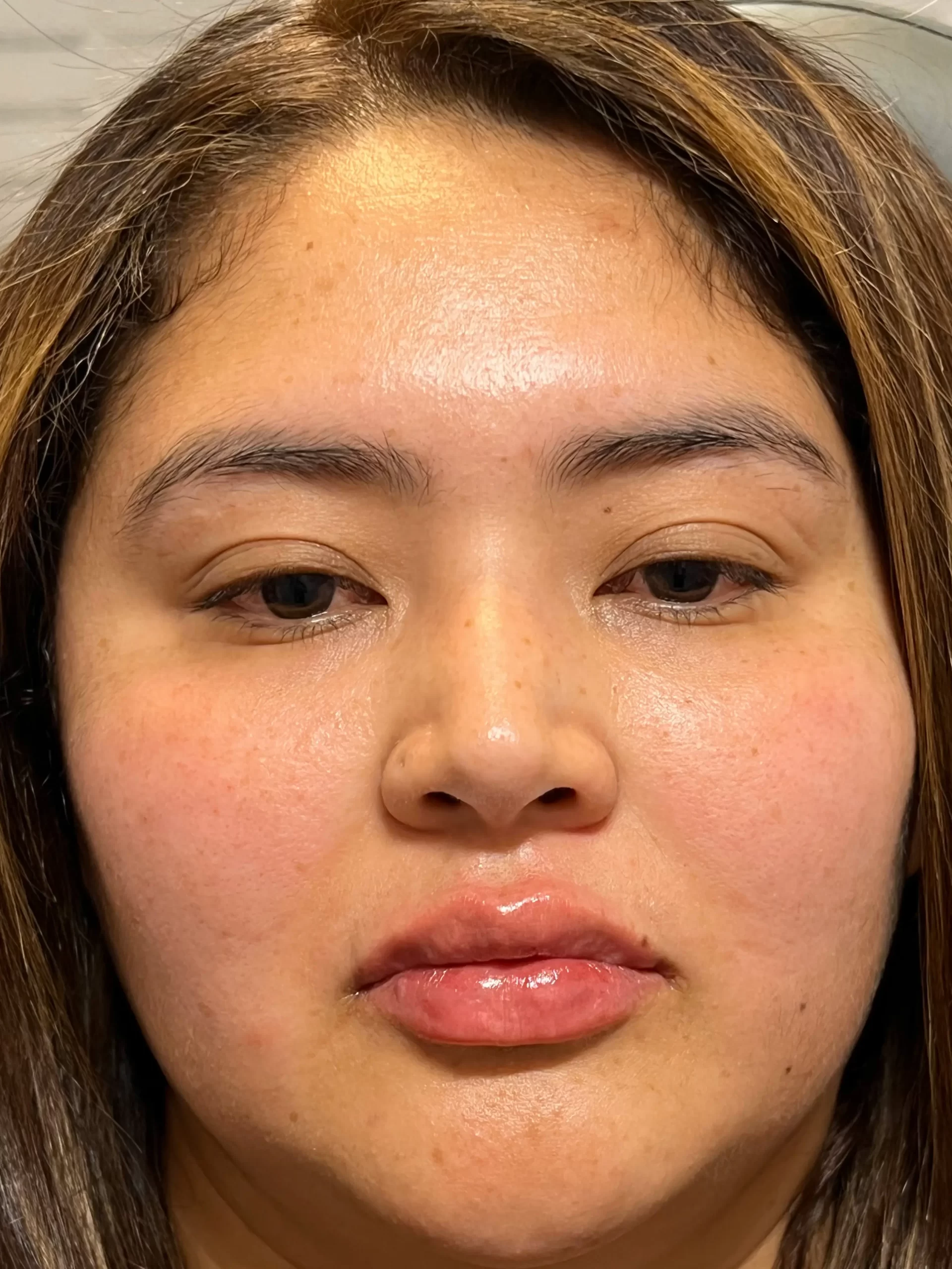 lip-filler-after (1) lip-filler-after (1)