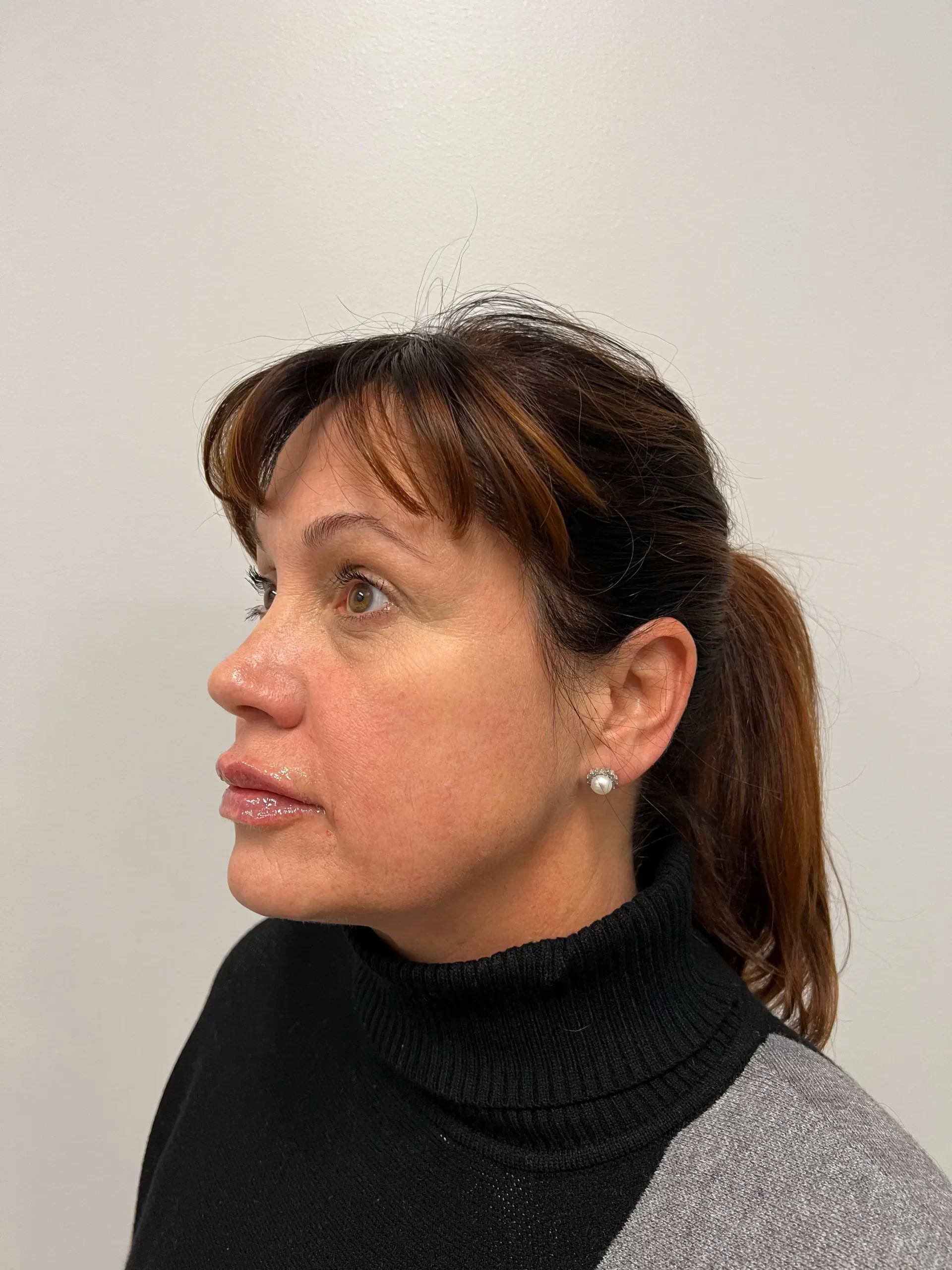 lip-filler-after-(2) lip-filler-after-(2)