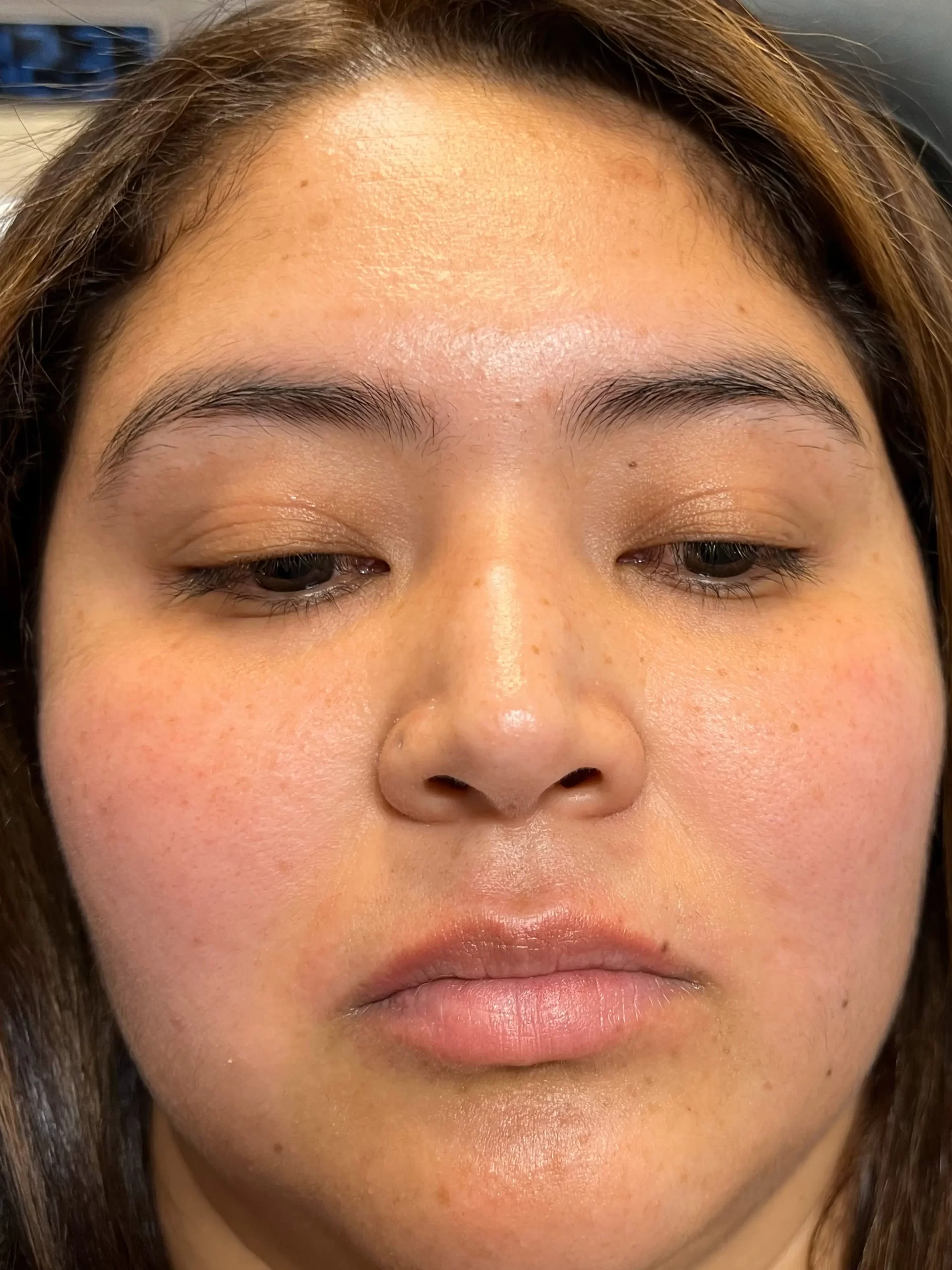 lip-filler-before (1) lip-filler-before (1)