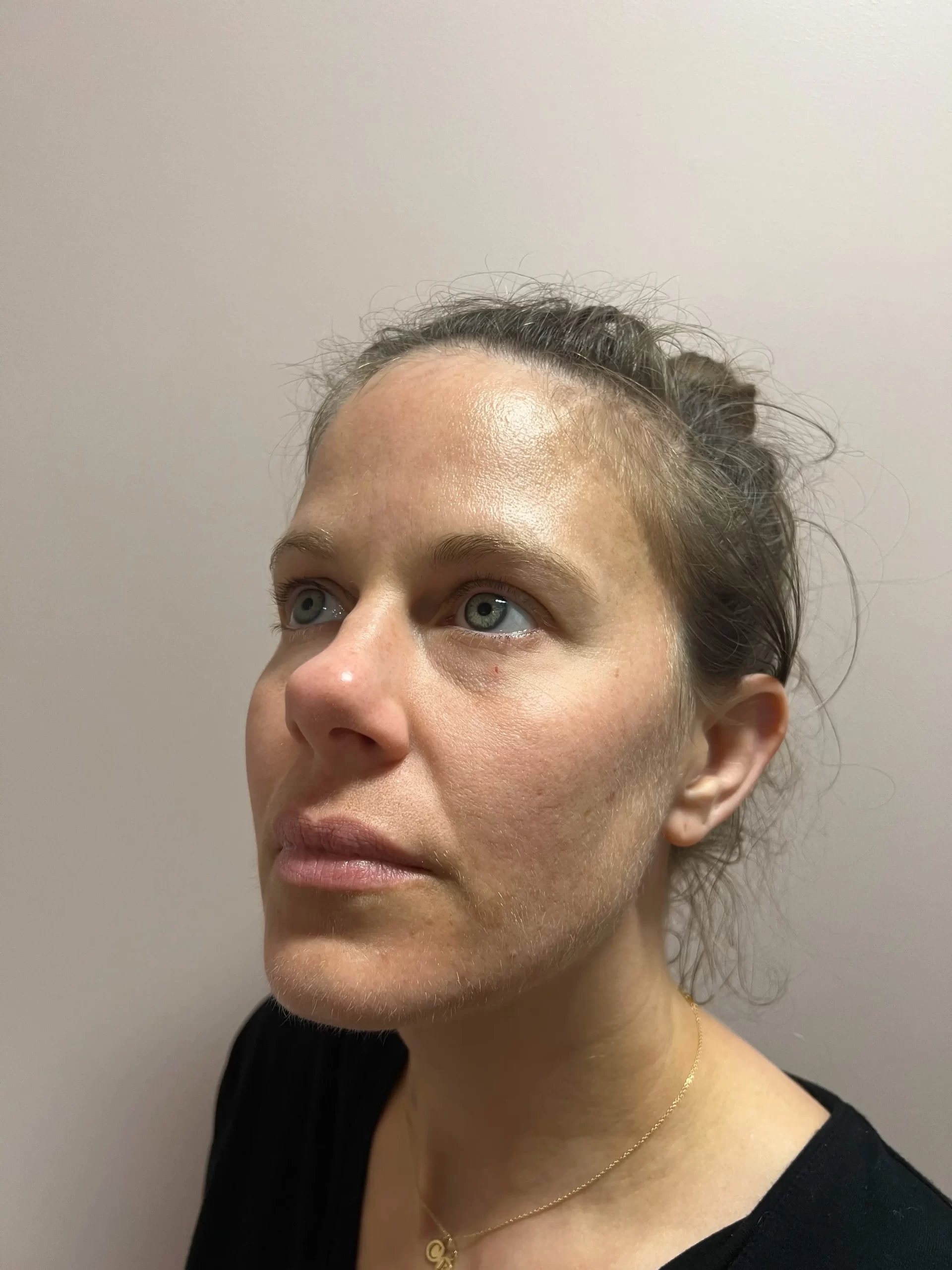 lip-filler-before-(3) lip-filler-before-(3)
